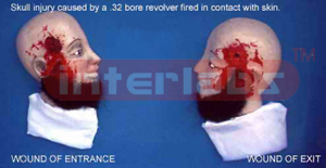 Skull injury caused by a .32 bore revolver fired in contact with skin